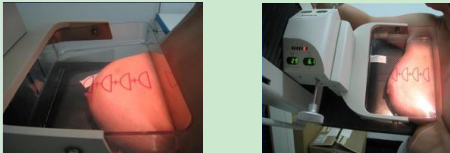 乳腺x线摄影(钼靶)检查知多少